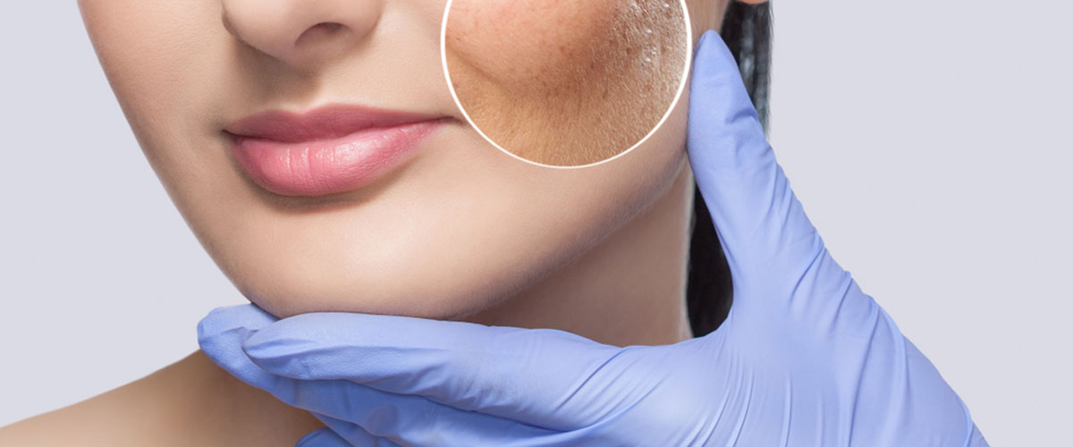 Acne and Acne Scar treatment in kharghar, Navi Mumbai by Dr. Gunjan Gangaraju