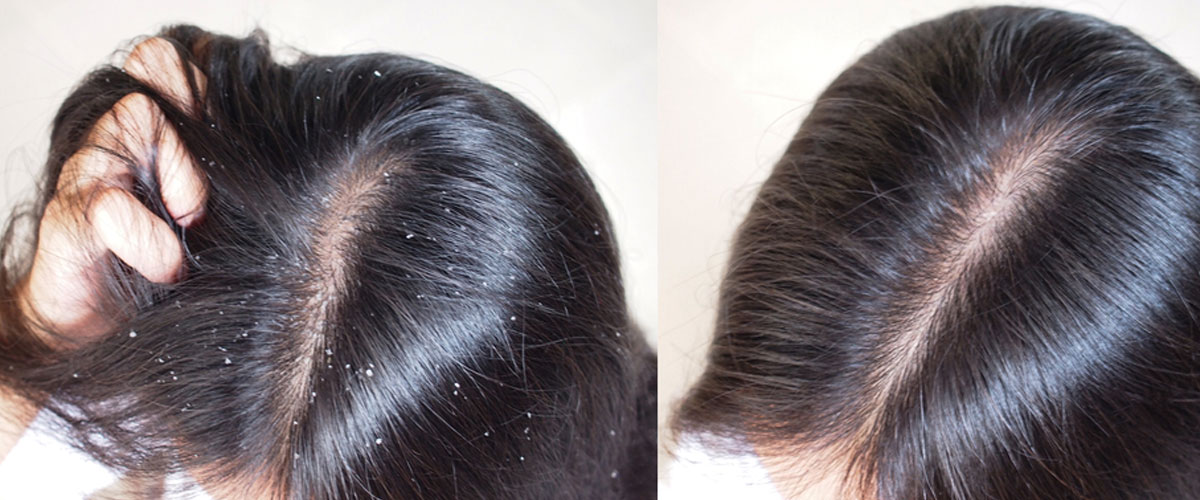 Anti Dandruff treatment in kharghar, Navi Mumbai by Dr. Gunjan Gangaraju