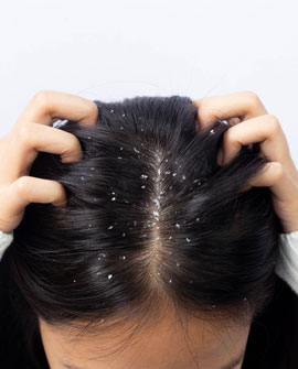 Anti Dandruff treatment in kharghar, Navi Mumbai by Dr. Gunjan Gangaraju