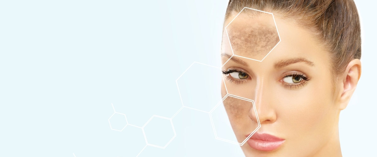 Pigmentation treatment in kharghar, Navi Mumbai by Dr. Gunjan Gangaraju